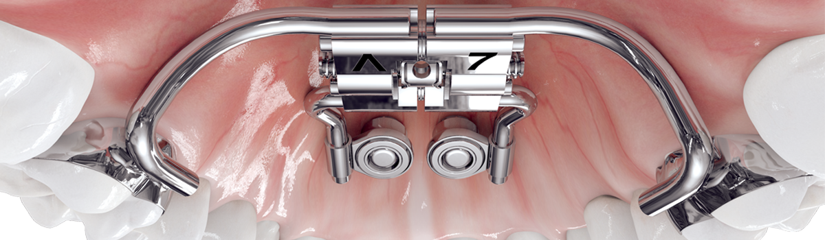 alt="tomas abutment"