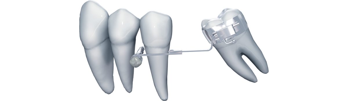 alt="elementi di accoppiamento per ancoraggio scheletrico ortodontico"